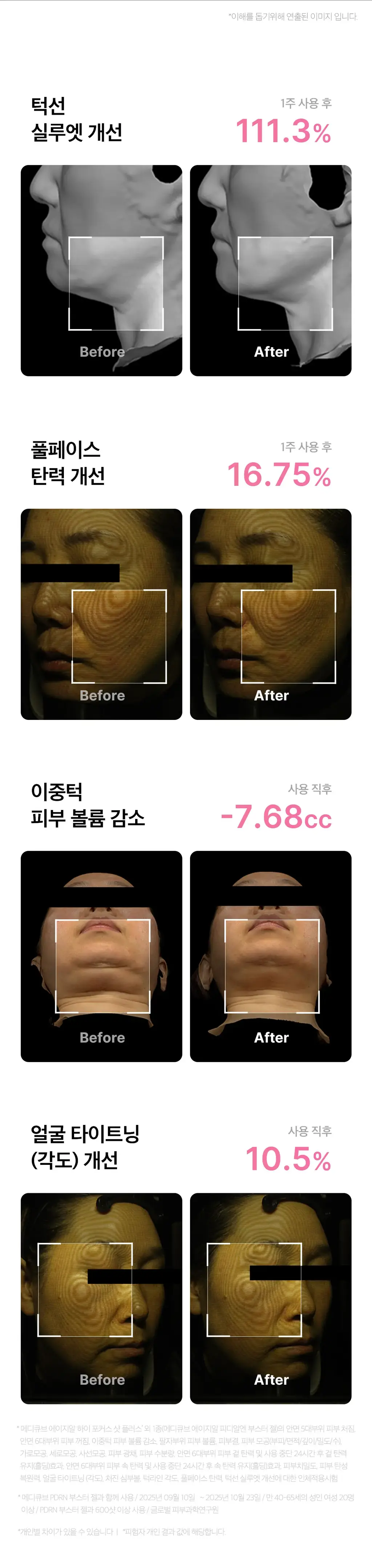 [고강도초음파] 메디큐브 에이지알 하이포커스샷 플러스 (핑크/베이지) 상세페이지 22